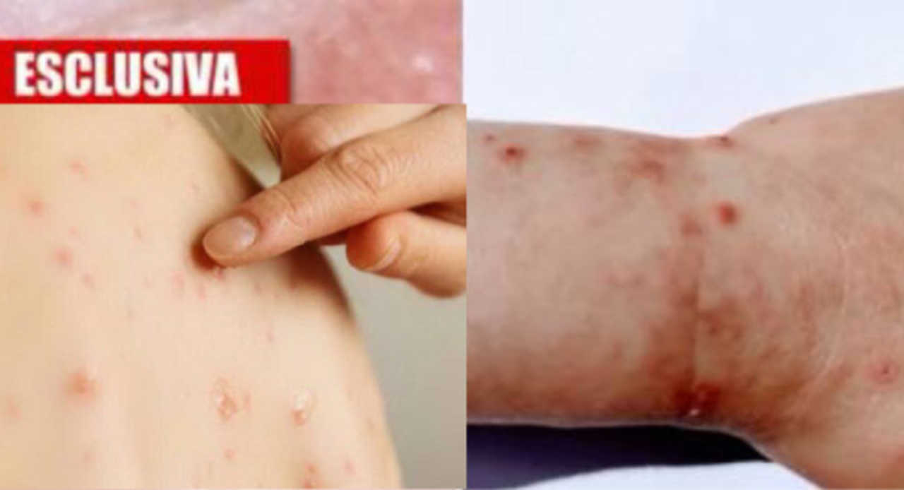 Coronavirus Si Vede Anche Sulla Pelle Ecco Come Si Manifesta Il Covid 19 Parla L Esperto Ilmeteo It
