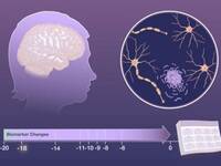 Alzheimer: la malattia può essere riconosciuta tra 14 e 18 anni prima della Diagnosi; i dettagli